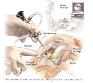artroscopia