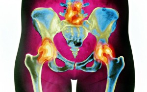 Artrite do quadril é uma das causas das dores em atletas, principalmente os mais velhos (Foto: Getty Images)