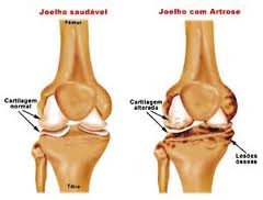 artróza a osteoartróza pete roșii pe articulații și rănite