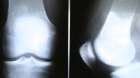 Exame de raio-x em um joelho: sintomas da doença são dor, rangidos ou estalos na região anterior do joelho