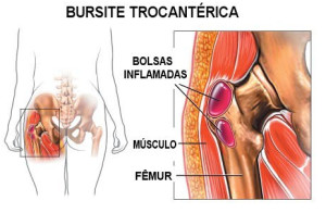 Anatomia e inflamação das bolsas na bursite trocantérica